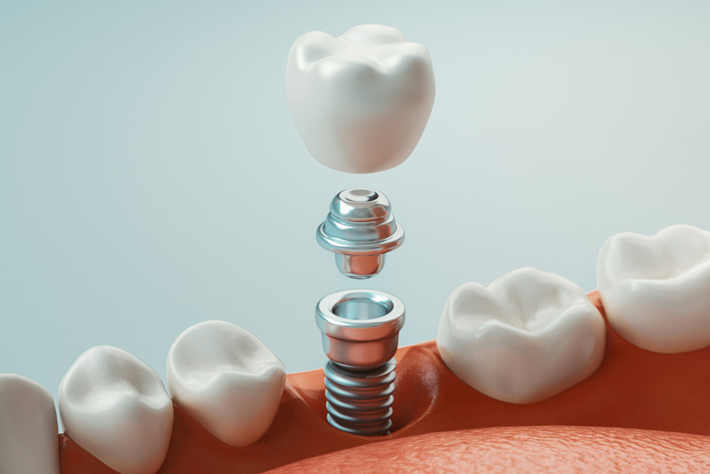 dental implants