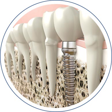 Replacing Multiple Teeth With Dental Implants