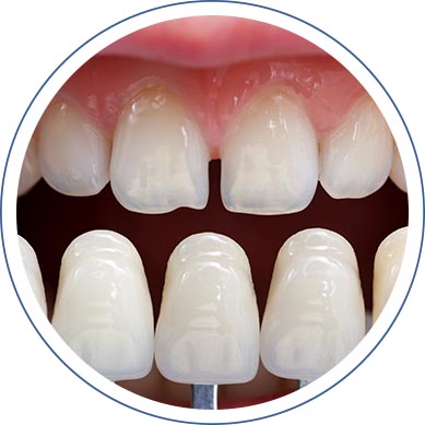 Porcelain Dental Veneers